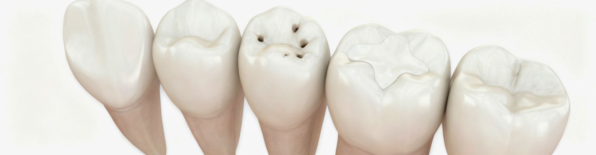 Rendering of a row of teeth with cavities.